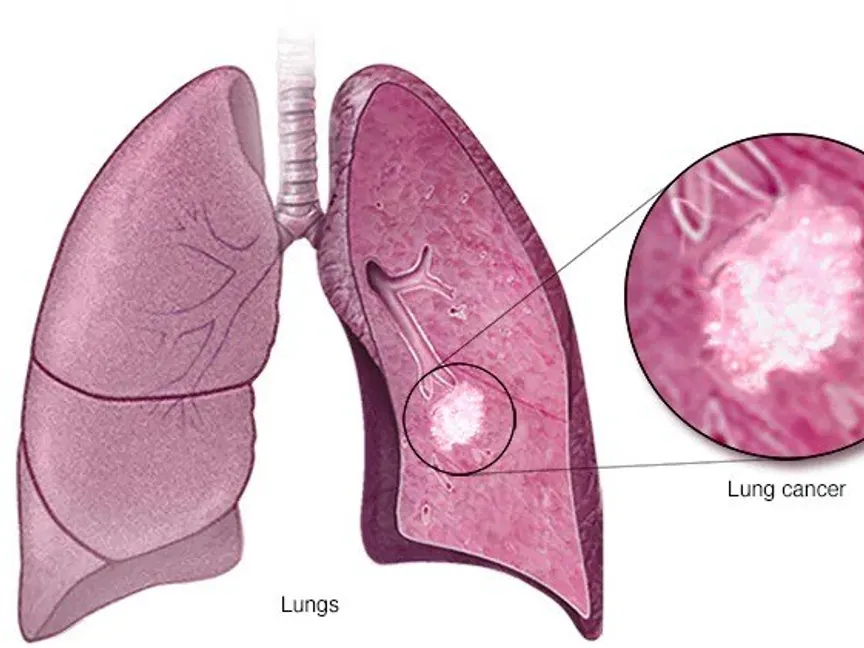 علاج مناعي جديد يغير مسار علاج سرطان الرئة.. شاهد التفاصيل