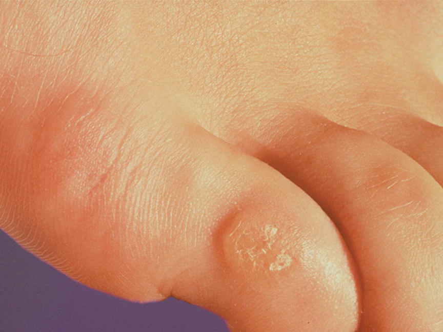 مسمار لحمي في القدم. - مايو كلينيك