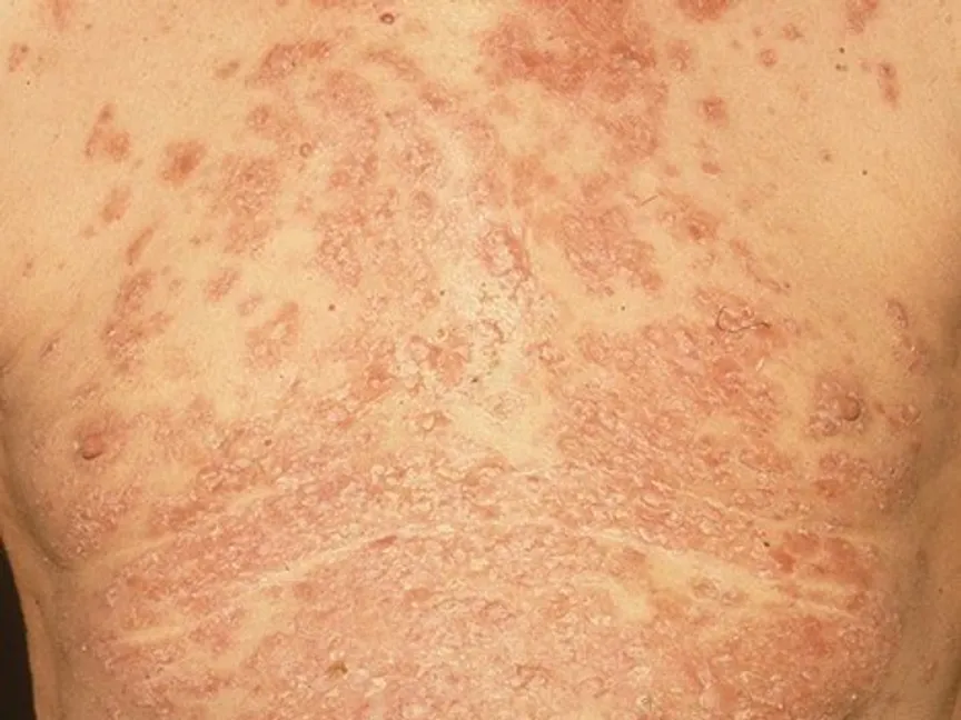 مصاب بالفقاع إذ تظهر بثور وقروح على الجلد - مايو كلينك