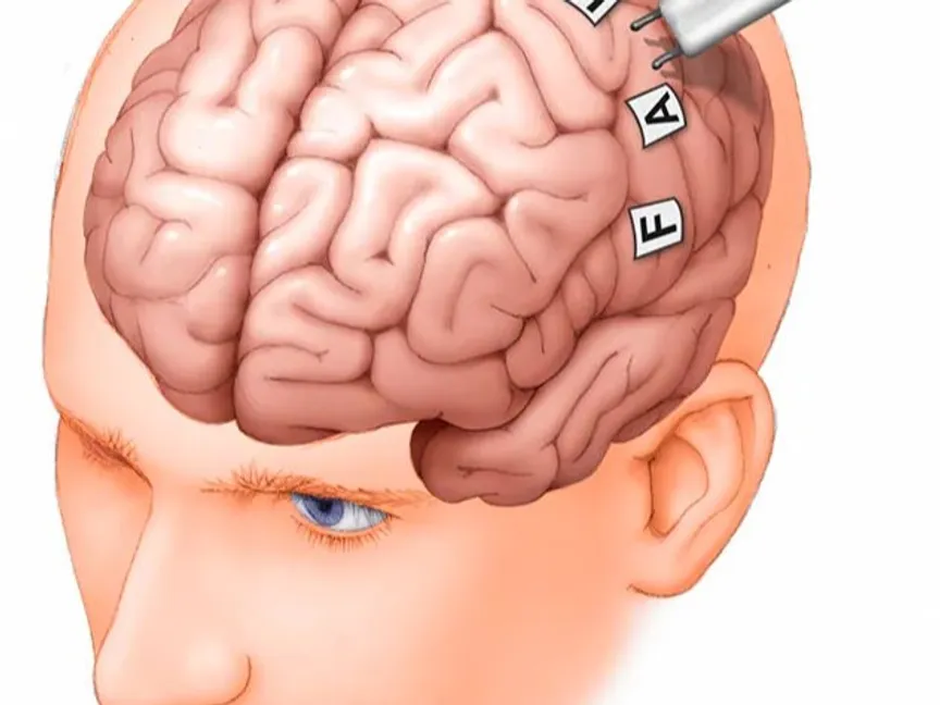 يحدد الطبيب في أثناء رسم خرائط الدماغ مناطق الدماغ التي تتحكم في الرؤية والكلام والحركة لتحديد الموقع الدقيق لإجراء جراحة الدماغ دون الحد من وظيفة الدماغ. - mayoclinic.org