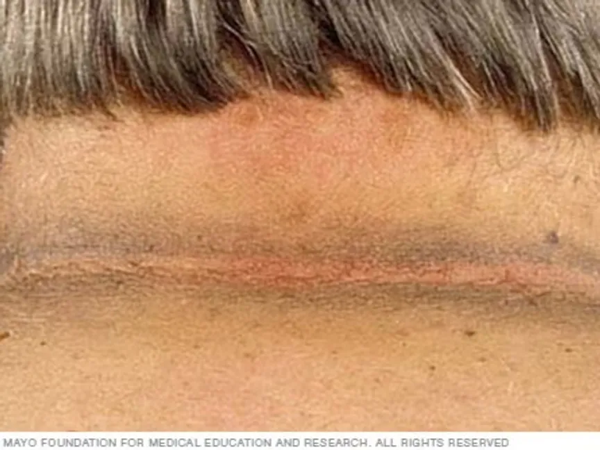 الشواك الأسود حالة تتسبب في تلون طيات الجسم وتجاعيده باللون الأسود. - مايو كلينك