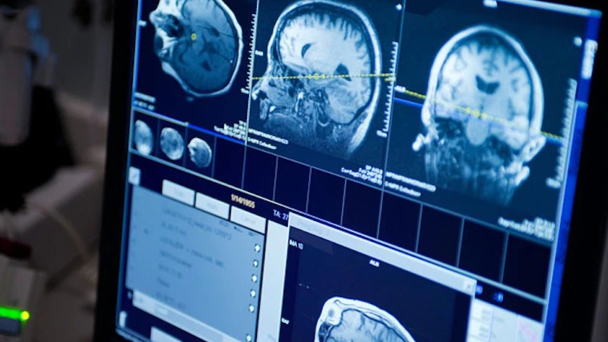 ماذا يحمي الدماغ من التدهور المعرفي؟