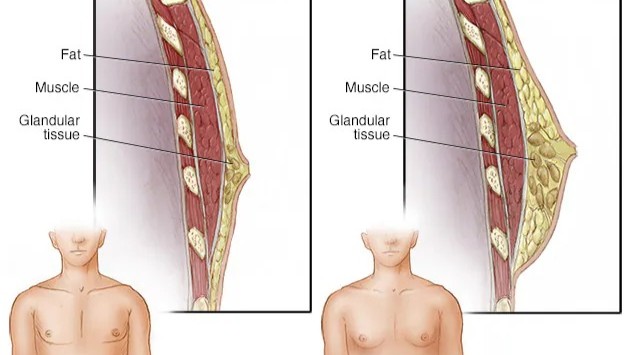 التثدي عند الرجال.. أعراض مزعجة يمكن التخلص منها بسهولة