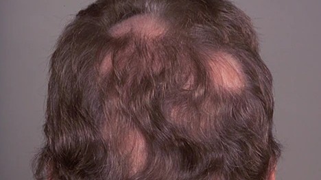 أسباب تساقط الشعر.. دليل الرجال والنساء للوقاية والعلاج