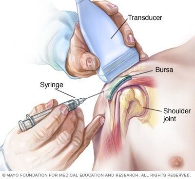 يمكن لحقن دواء الكورتيكوستيرويد في الجراب أن يخفف الألم والتهاب الجراب - mayoclinic.org/