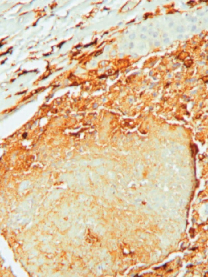 السرطان يربك الساعة البيولوجية للدماغ ويضعف استجابة الجسم 