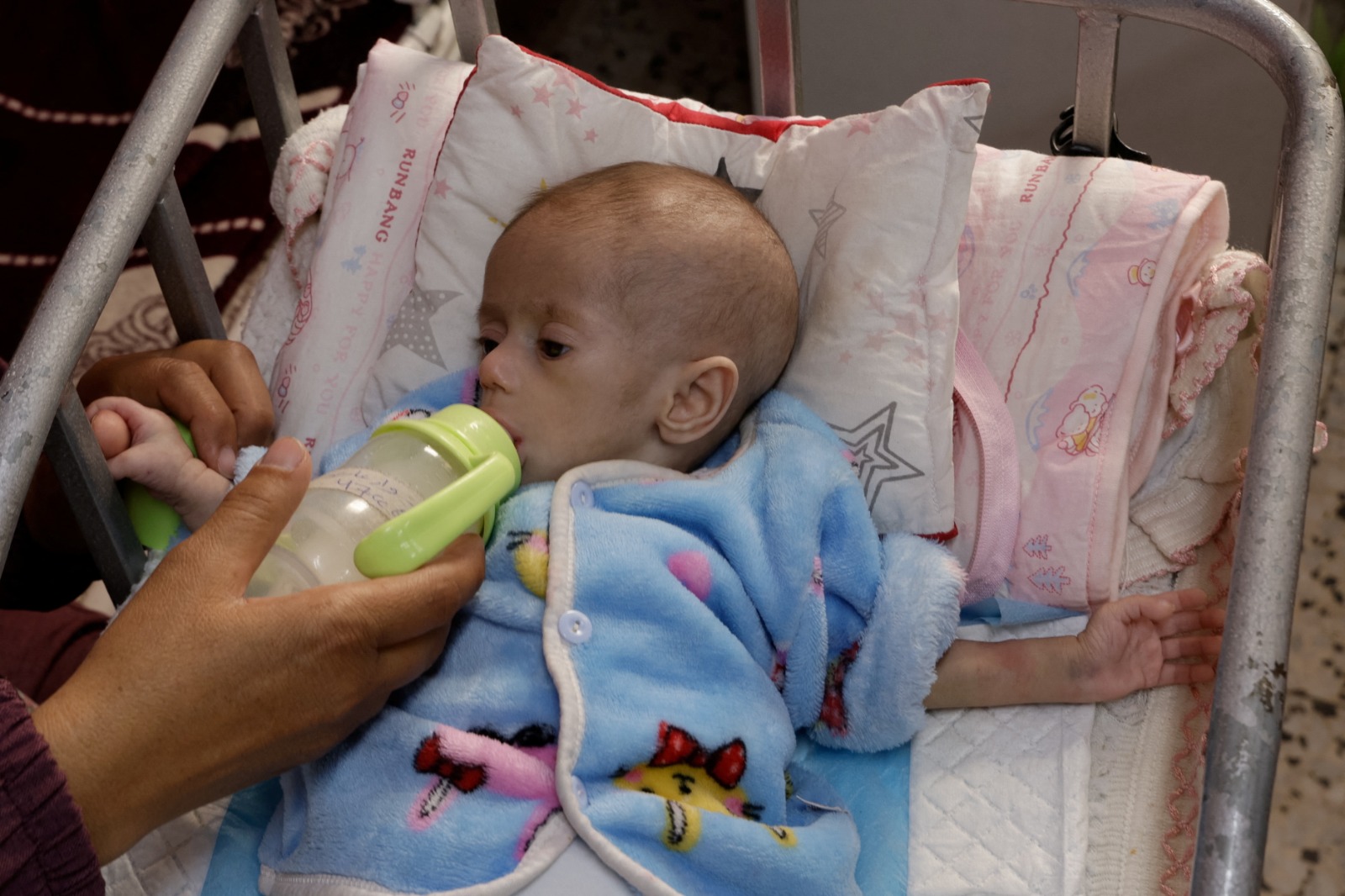 رضيعة فلسطينية تعاني من سوء التغذية في مستشفى ناصر جنوب قطاع غزة. 30 أبريل2025