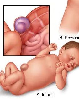 الفتق السري لدى الرضع. - مايو كلينيك