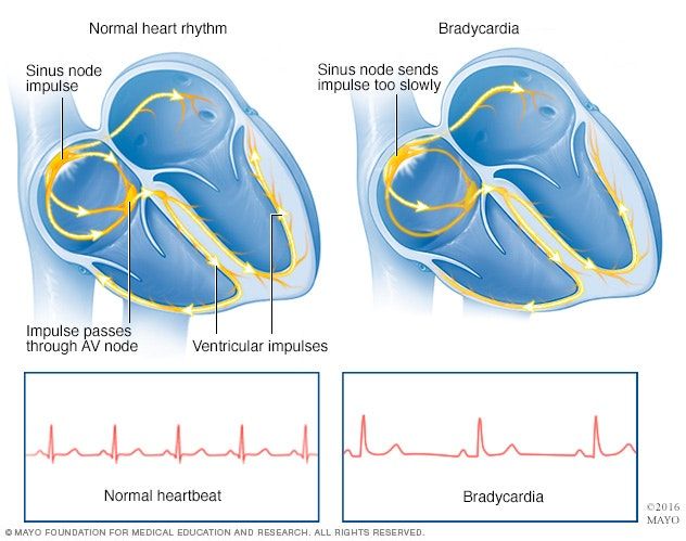 صورة تُظهر نبضات القلب الطبيعية (يسار) والاخرى تظهر بطء النبضات (يمين). مايو كلينيك