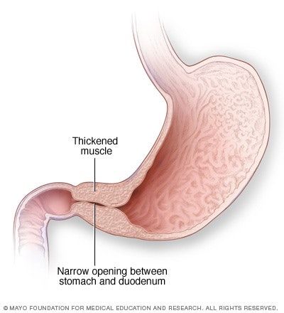 صورة توضيحية لحالة تضيُّق بواب المعدة في الأطفال الصغار - www.mayoclinic.org