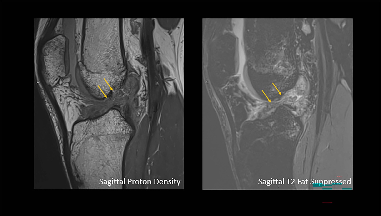 تظهر الأسهم تمزقا كاملا في الرباط الصليبي الأمامي لدى شاب يبلغ من العمر 18 عاما تعرض لإصابة في الركبة أثناء لعب كرة القدم.