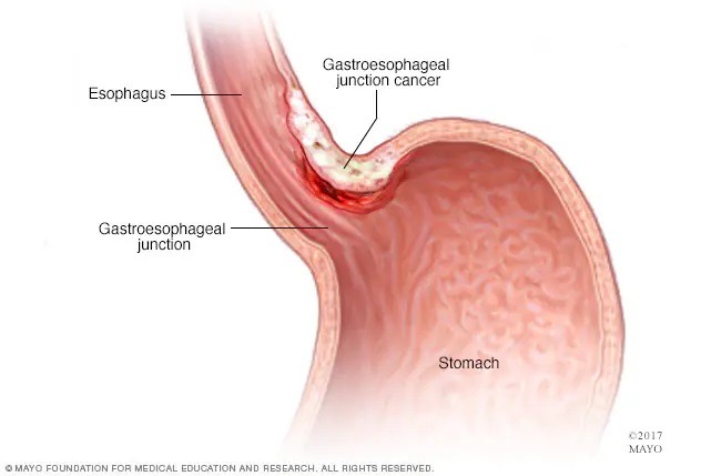 يتطور سرطان الموصل المعدي المريئي في المنطقة التي يتصل فيها المريء بالجزء العلوي من المعدة