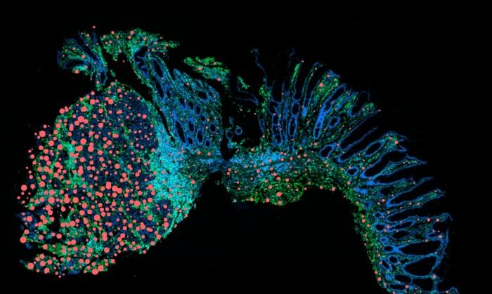صورة توضيحية تظهر بروتين Oncostatin M في محيط الأورام (باللون الأحمر) وبدرجة أقل في الأنسجة المعوية السليمة ذات البنية الخلوية الطبيعية (يمين). 3 يونيو 2025