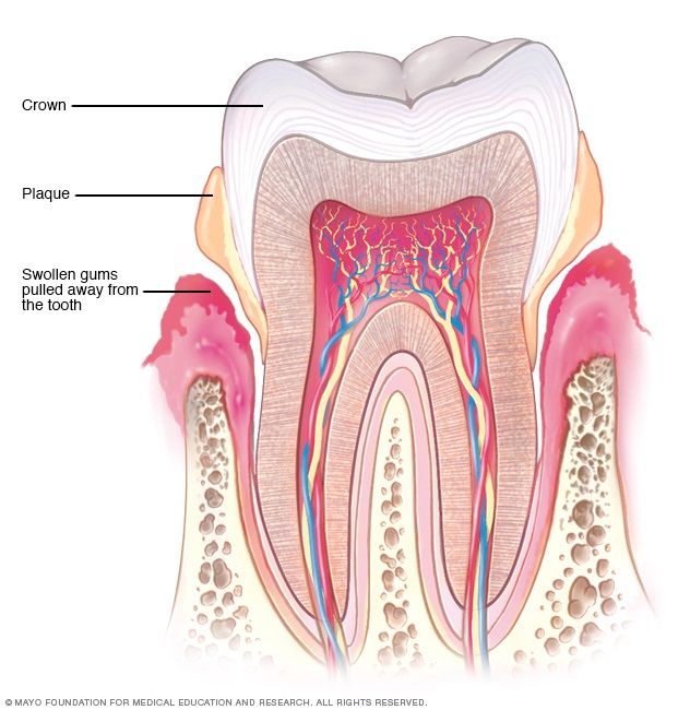 التهاب اللثة عدوى فيروسية شديدة يمكن أن تؤدي إلى مضاعفات صحية خطيرة - mayoclinic