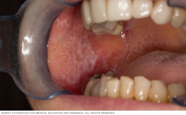 تسبب آفات الحزاز المسطح في الفم رقع بيضاء شريطية في الفم