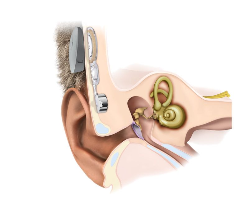 طريقة عمل تقنية توصيل الأصوات عبر عظم الأذن Bone Conduction - Med-EL