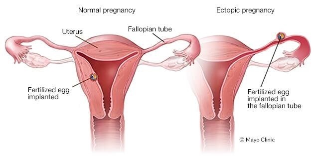 في الحمل الصحي والسليم، تعلق البويضة المخصبة نفسها في بطانة الرحم أما في الحمل المنبِذ، تعلق البويضة نفسها في مكان ما خارج الرحم، وعادة داخل قناة فالوب