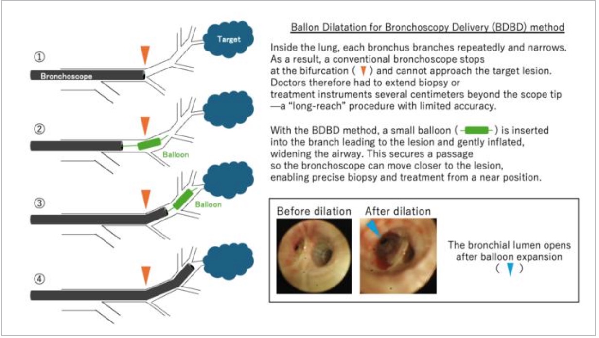 يستطيع البالون الوصول لأعماق العقد الطرفية في الرئة