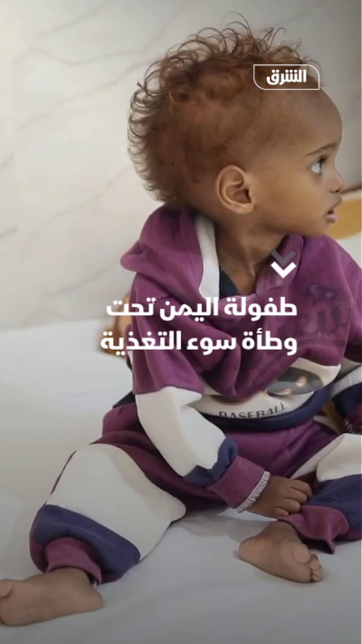 اليمن.. أكثر من مليوني طفل يواجهون شبح سوء التغذية، والقتال والنزوح يفاقمان الأزمة.