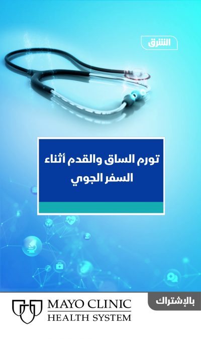تورم الساق والقدم أثناء السفر الجوي